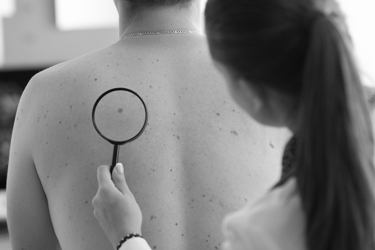 Doctor Looking At Patients Moles On Their Back, Black And White