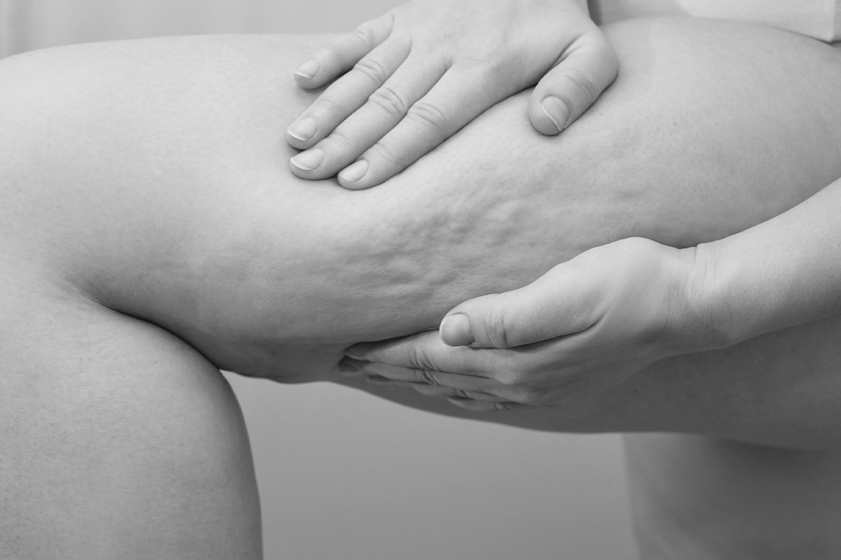 A Woman Holding Her Thigh, Looking At Cellulite On Her Leg, Black And White Photo