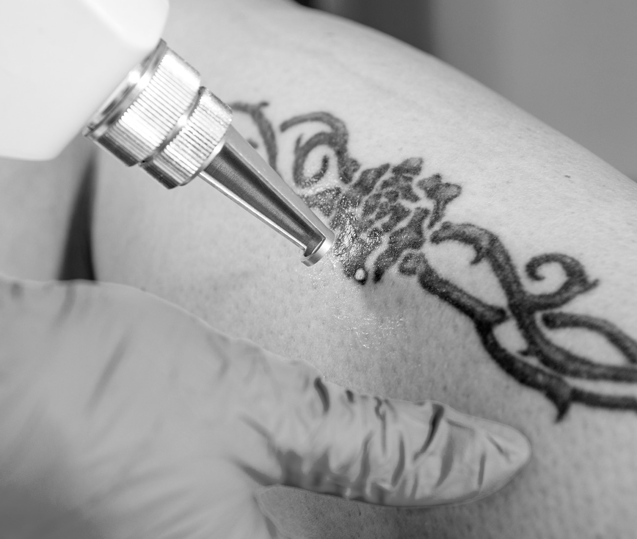 A Close Up Of Someone Having A Tattoo Removed On Some Part Of Their Body, Black And White Photo