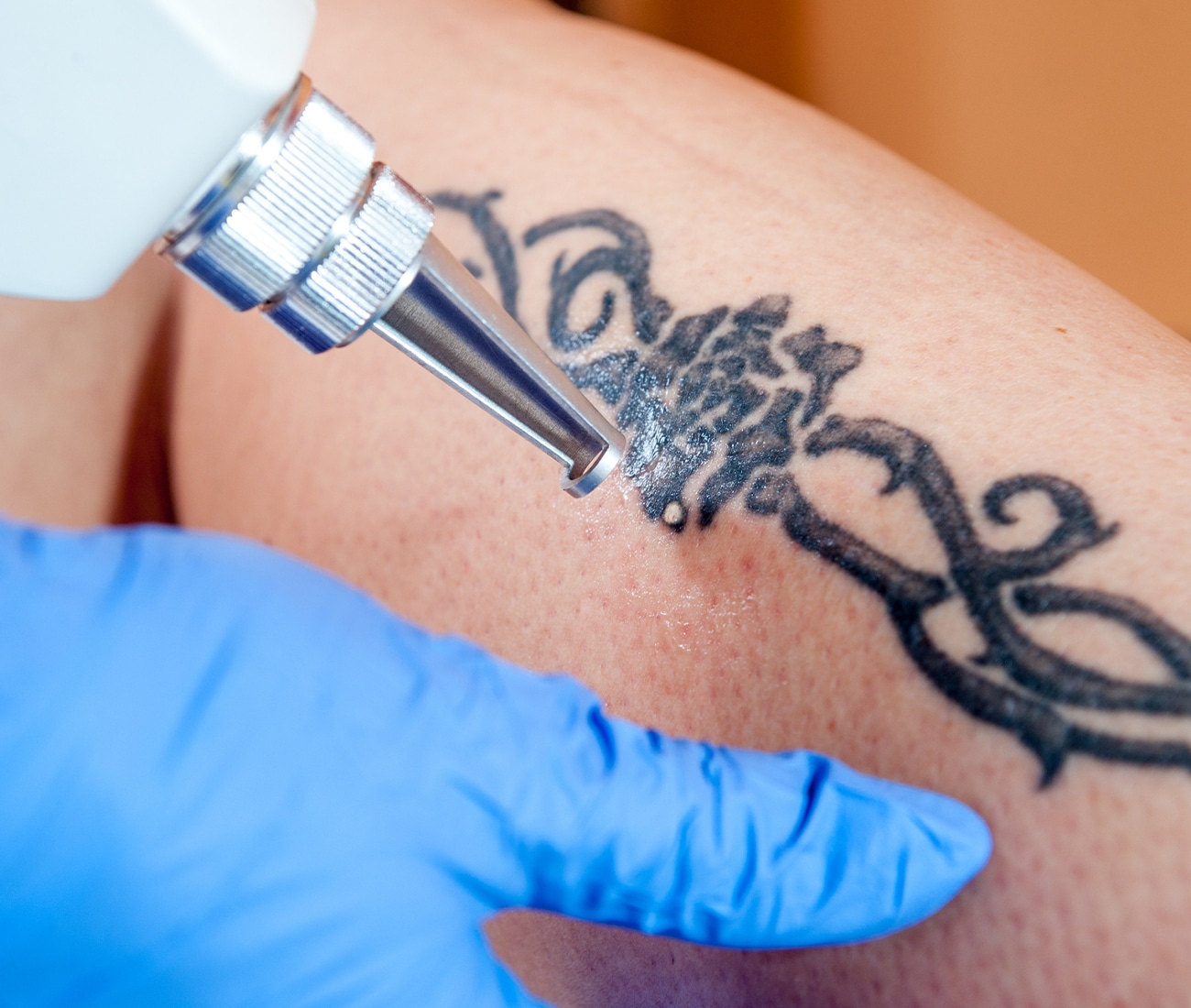 Patient Having Tattoo Removed