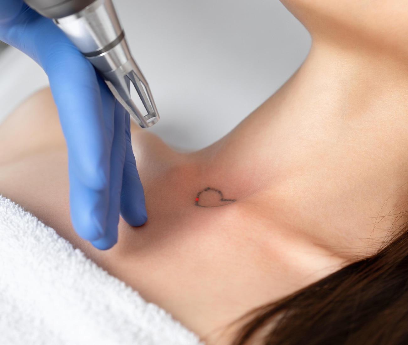 A Patient Receiving Laser Tattoo Removal Treatment